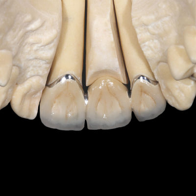 خرید کاخ فرنگی غیر قیمتی PFM Crown Implant Fused To Metal Crown online manufacture