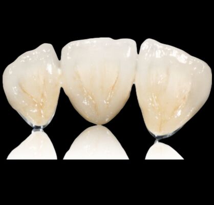 خرید تاج یا پل نيمه گرانبها قابل سفارشي سازي تاج و پل آلياژ گرانبها online manufacture