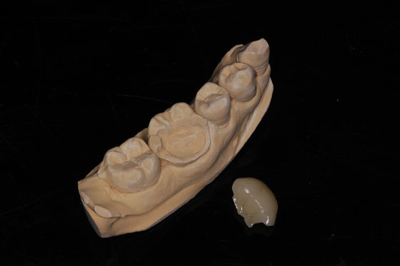 دندان ساز ترکیبی پوشش دادن Veneer High Aesthetics Composite Veneer
